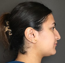 Rhinoplasty Before Photo by Mark Albert, MD; New York, NY - Case 49133