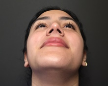 Rhinoplasty After Photo by Mark Albert, MD; New York, NY - Case 49133