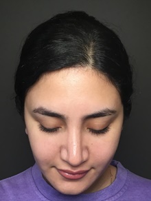 Rhinoplasty After Photo by Mark Albert, MD; New York, NY - Case 49133