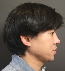 Rhinoplasty After Photo by Mark Albert, MD; New York, NY - Case 49135