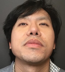 Rhinoplasty After Photo by Mark Albert, MD; New York, NY - Case 49135