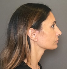 Facelift After Photo by Mark Albert, MD; New York, NY - Case 49136