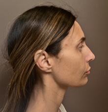 Facelift Before Photo by Mark Albert, MD; New York, NY - Case 49136