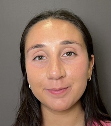 Rhinoplasty After Photo by Mark Albert, MD; New York, NY - Case 49148