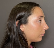 Rhinoplasty After Photo by Mark Albert, MD; New York, NY - Case 49148