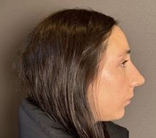 Rhinoplasty Before Photo by Mark Albert, MD; New York, NY - Case 49148