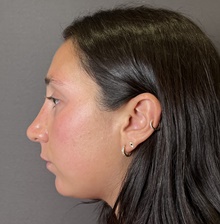 Rhinoplasty After Photo by Mark Albert, MD; New York, NY - Case 49148