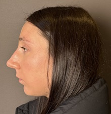 Rhinoplasty Before Photo by Mark Albert, MD; New York, NY - Case 49148