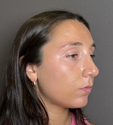 Rhinoplasty After Photo by Mark Albert, MD; New York, NY - Case 49148