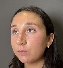 Rhinoplasty After Photo by Mark Albert, MD; New York, NY - Case 49148