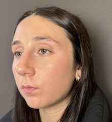 Rhinoplasty Before Photo by Mark Albert, MD; New York, NY - Case 49148