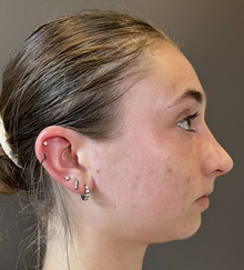 Rhinoplasty After Photo by Mark Albert, MD; New York, NY - Case 49153