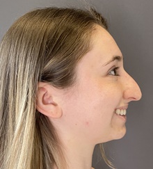 Rhinoplasty Before Photo by Mark Albert, MD; New York, NY - Case 49153