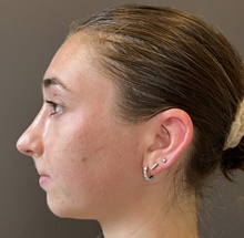 Rhinoplasty After Photo by Mark Albert, MD; New York, NY - Case 49153