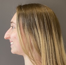 Rhinoplasty Before Photo by Mark Albert, MD; New York, NY - Case 49153