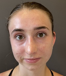 Rhinoplasty After Photo by Mark Albert, MD; New York, NY - Case 49153