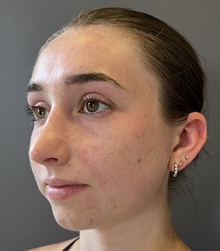 Rhinoplasty After Photo by Mark Albert, MD; New York, NY - Case 49153