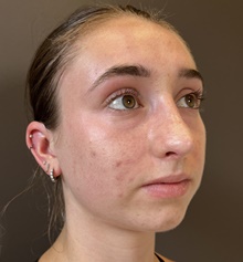 Rhinoplasty After Photo by Mark Albert, MD; New York, NY - Case 49153