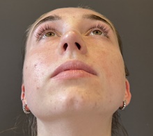 Rhinoplasty After Photo by Mark Albert, MD; New York, NY - Case 49153