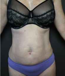 Liposuction After Photo by Mark Albert, MD; New York, NY - Case 49154