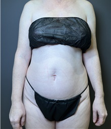 Liposuction Before Photo by Mark Albert, MD; New York, NY - Case 49154