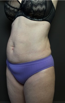 Liposuction After Photo by Mark Albert, MD; New York, NY - Case 49154