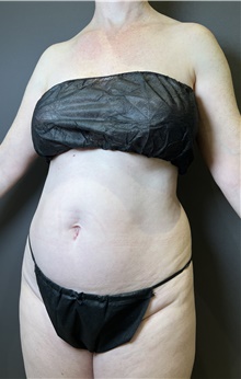 Liposuction Before Photo by Mark Albert, MD; New York, NY - Case 49154