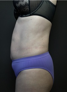 Liposuction After Photo by Mark Albert, MD; New York, NY - Case 49154