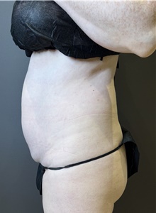 Liposuction Before Photo by Mark Albert, MD; New York, NY - Case 49154