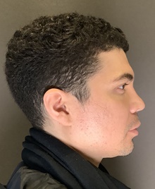 Rhinoplasty After Photo by Mark Albert, MD; New York, NY - Case 49158