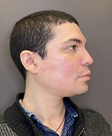 Rhinoplasty Before Photo by Mark Albert, MD; New York, NY - Case 49158