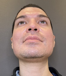 Rhinoplasty Before Photo by Mark Albert, MD; New York, NY - Case 49158