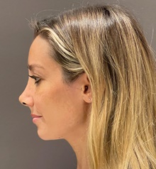 Rhinoplasty After Photo by Mark Albert, MD; New York, NY - Case 49159