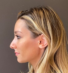 Rhinoplasty Before Photo by Mark Albert, MD; New York, NY - Case 49159