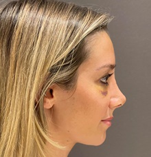 Rhinoplasty After Photo by Mark Albert, MD; New York, NY - Case 49159