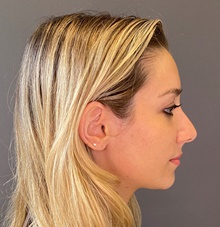 Rhinoplasty Before Photo by Mark Albert, MD; New York, NY - Case 49159