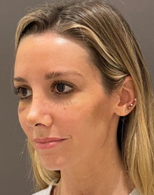 Rhinoplasty After Photo by Mark Albert, MD; New York, NY - Case 49159