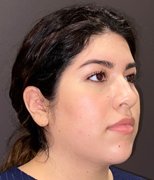 Liposuction Before Photo by Mark Albert, MD; New York, NY - Case 49161