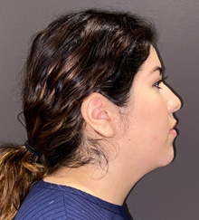 Liposuction Before Photo by Mark Albert, MD; New York, NY - Case 49161