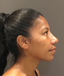 Rhinoplasty After Photo by Mark Albert, MD; New York, NY - Case 49325