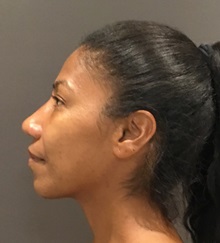 Rhinoplasty After Photo by Mark Albert, MD; New York, NY - Case 49325