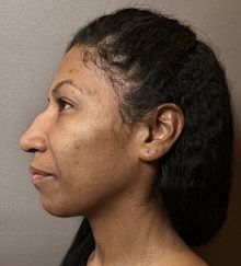 Rhinoplasty Before Photo by Mark Albert, MD; New York, NY - Case 49325