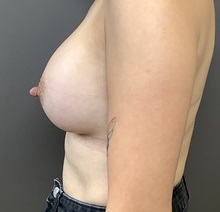 Breast Augmentation After Photo by Mark Albert, MD; New York, NY - Case 49318