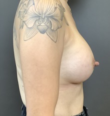 Breast Augmentation After Photo by Mark Albert, MD; New York, NY - Case 49318