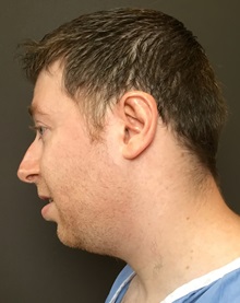 Chin Augmentation Before Photo by Mark Albert, MD; New York, NY - Case 49319