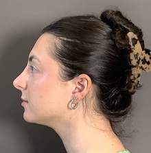 Rhinoplasty After Photo by Mark Albert, MD; New York, NY - Case 49711