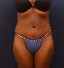 Tummy Tuck After Photo by Ross Blagg, MD; West Lake Hills, TX - Case 31375