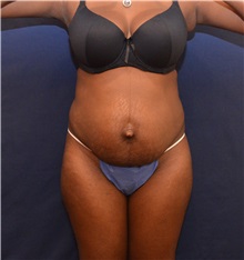 Tummy Tuck Before Photo by Ross Blagg, MD; West Lake Hills, TX - Case 31375