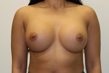 Breast Augmentation After Photo by James Lee, MD; Laval, QC - Case 35563