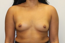 Breast Augmentation Before Photo by James Lee, MD; Laval, QC - Case 35563